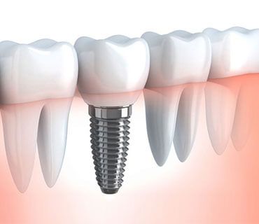 Dental Implant Illustration